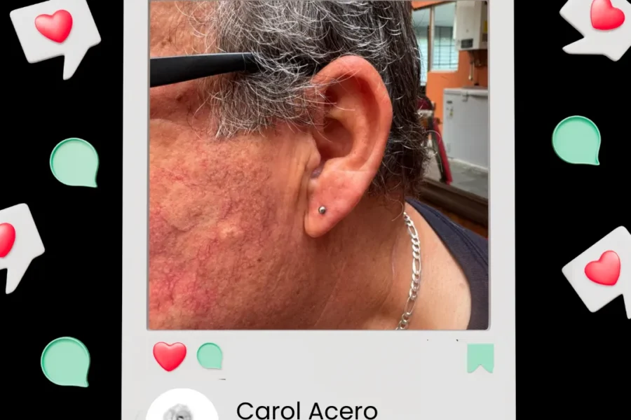 Carol Acero: Perforación humanizada a domicilio con Inverness